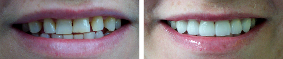 Before and After Veneers Photo