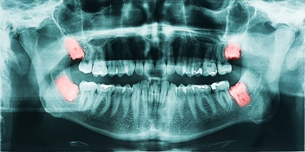 What are wisdom Teeth?